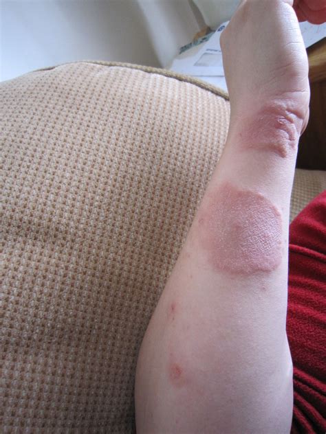 Sea Urchin Sting Rash | exousiavampira | Flickr