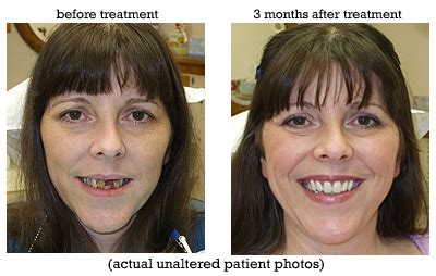 Cosmetic Natural Looking Dentures | Dentures Portland Oregon OR WA