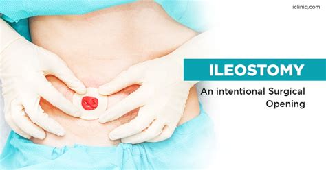 What Is Ileostomy?