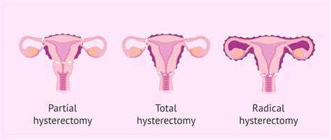 Hysterectomy - Richard Machado