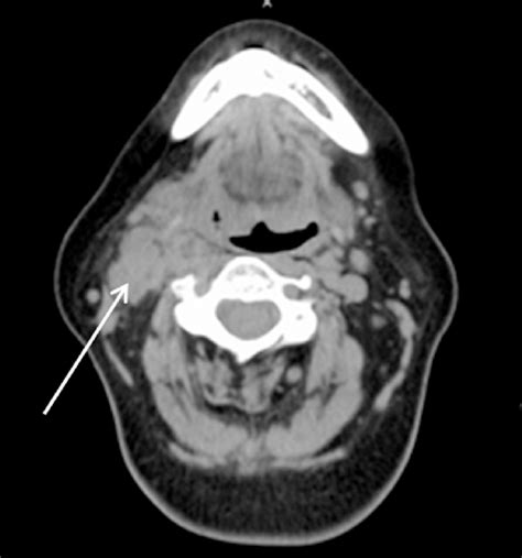 Ct Scan Enlarged Lymph Nodes Ct Scan Machine | Images and Photos finder