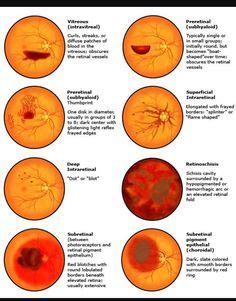 FUNDOSCOPY Eye Health Facts, Eye Retina, Diseases Of The Eye, Medicine Notes