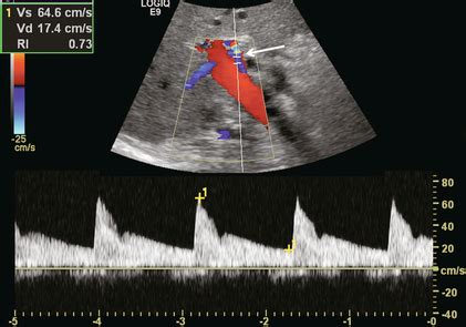 Hepatic Artery Ultrasound