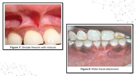 FRENAL ATTACHMENT & ITS MANAGEMENT | PPT