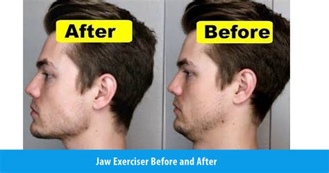 Jaw Exerciser Before and After – JawFlex®