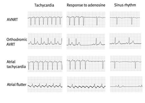 Paroxysmal Atrial Tachycardia Vs Sinus Tachycardia