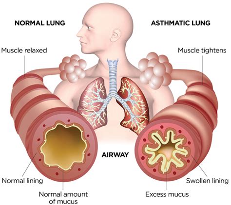 Asthma is a chronic condition – DailyNews