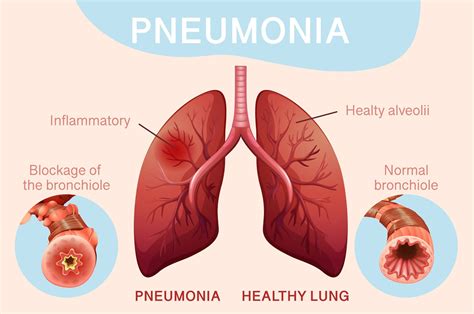 Pneumonia: Clinical Features, Treatment, and Complications ...