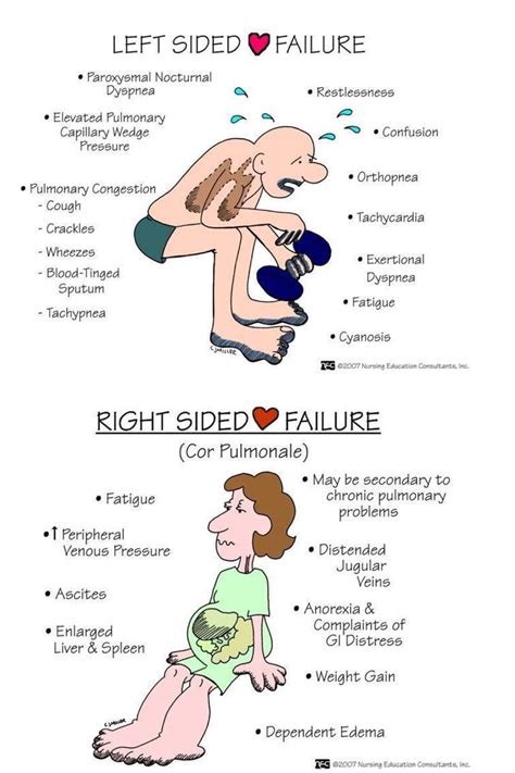 Left sided heart failure LVF and Right sides heart failure RVF #cardiac ...