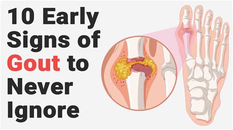 10 Early Signs of Gout to Never Ignore