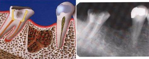 Cavitation - Odontomedik