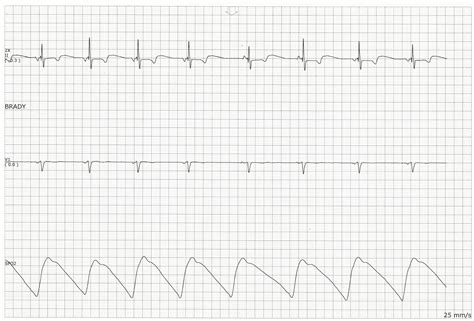 Float Nurse: Practice EKG Strips