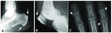 Radiographs of the ankle, knee, and hand of a patient with thoracic... | Download Scientific Diagram