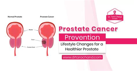 Vital Lifestyle Changes for Effective Prostate Cancer Prevention