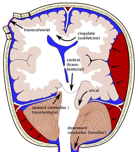 File:Brain herniation types-2.svg - Wikimedia Commons