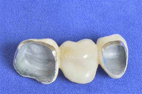 Essential Facts on Porcelain Fused to Metal (PFM) Restorations