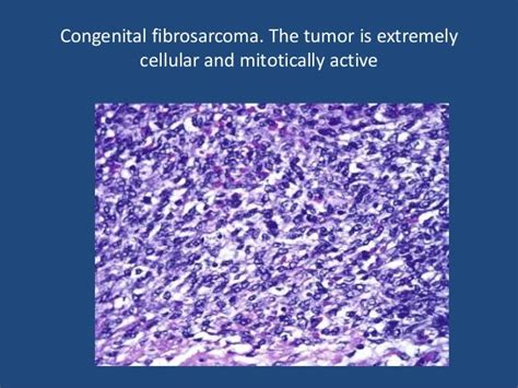 Soft tissue tumor