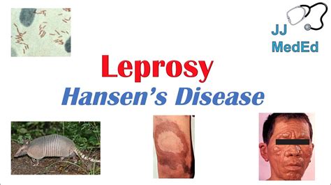 Does Leprosy Make You White? The 22 Correct Answer - Musicbykatie.com