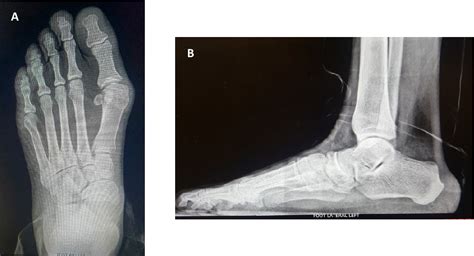 Figure 1 from Treatment of Chronic and Severe Pes Planovalgus Deformity using Sym align ® Evans ...