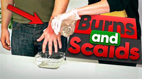 Burns and Scalds - First Aid Training - YouTube