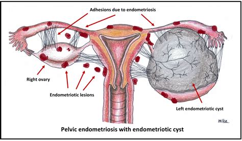 Endometriosis External / Endometriosis The Bmj - It manifests in three ...