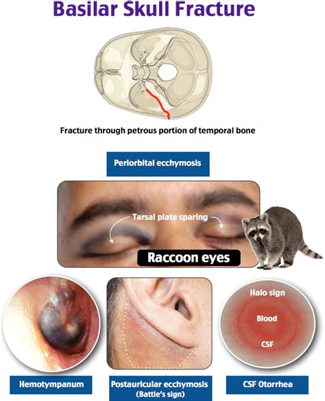 Today's Essential Teaching Image: Basilar Skull Fracture - RoshReview.com