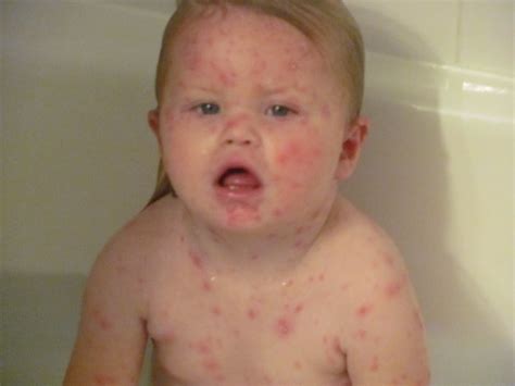 Chicken Pox | Chicken Pox Vaccine | Chicken Pox Pictures | Chicken Pox ...