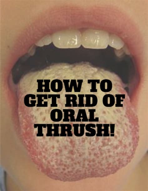 9 Methods for How to Battle Oral Thrush | RemedyGrove