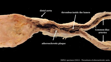 Gross Anatomy and Histopathology of Atherosclerosis – Pathology