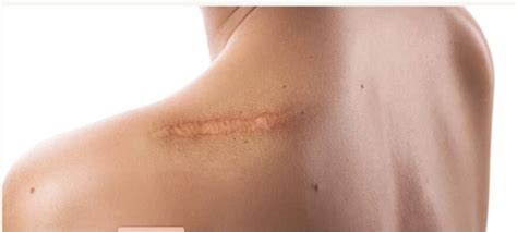 How To Diminish Post Surgical Scars - Sanara MedTech