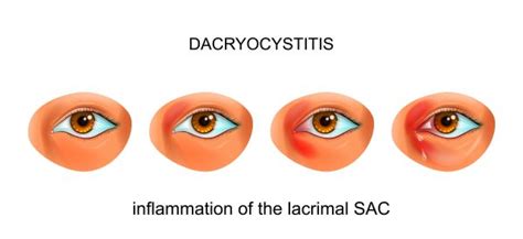 Acute Dacryocystitis