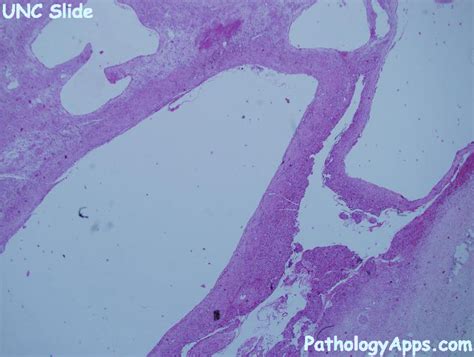 aneurysmal bone cyst bone histology