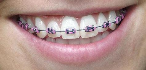 352 Best Braces images in 2020 | Braces, Teeth braces, Braces colors