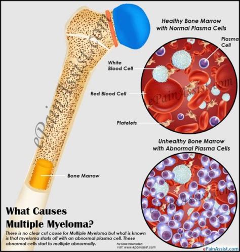 Multiple Myeloma- "Miracle Cancer Cures" Pros and Cons- PeopleBeatingCancer