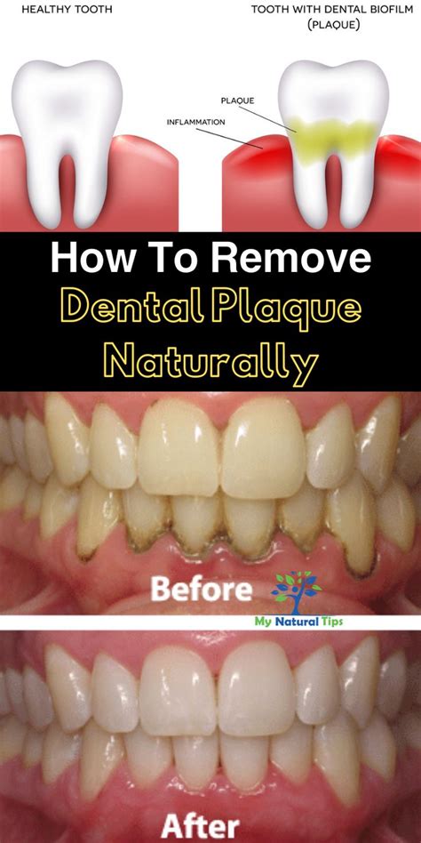 How To Remove Plaque From Teeth With Dental Pick | NeCitizen