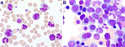 a Peripheral blood smear from a patient with CMML demonstrating... | Download Scientific Diagram