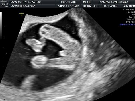 down syndrome baby at 14 weeks ultrasound - Lilliam Steel