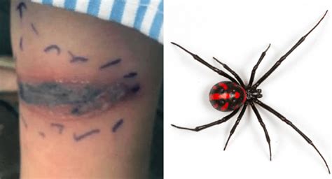 False Black Widow Bite Treatment / How to spot false widow spiders: What to do if the False ...