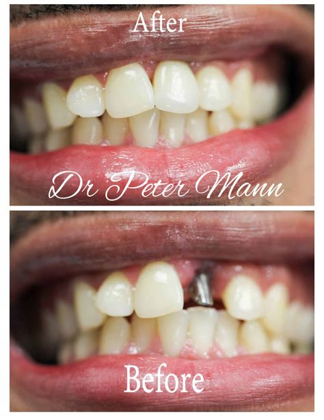 Dental Implants before and after photo | Manhattan | Dentist