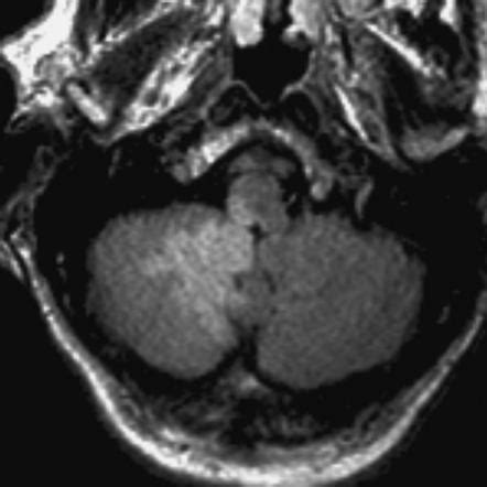 Cerebellar Stroke Mri