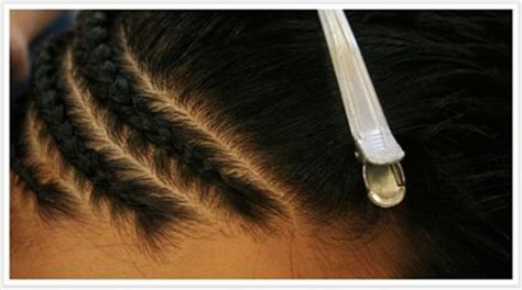 Traction Alopecia, Causes and Treatment