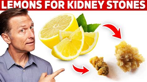 Eliminate Kidney Stones With Lemons – Kidney Stone Causes & Lemon Benefits – Dr.Berg - YouTube