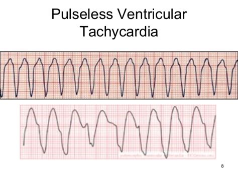 What Is Pulseless Ventricular Tachycardia? - IYTmed.com