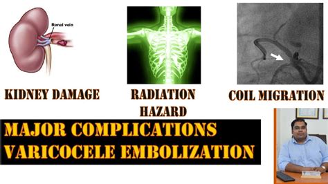 Complications of Varicocele Embolization | Microsurgery vs Embolization ...