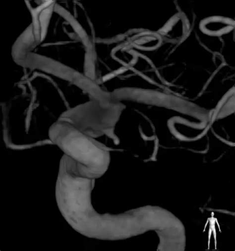 Left pterional craniotomy for posterior communicating artery aneurysm ...