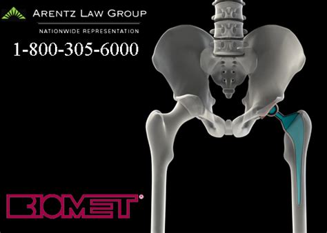 Biomet Hip Lawyers