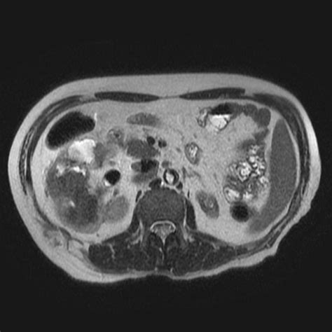 Pyelonephritis MRI - wikidoc