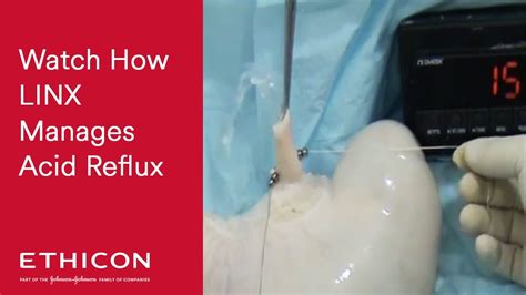 LINX Acid Reflux Management System - Yield Pressure | ETHICON - YouTube