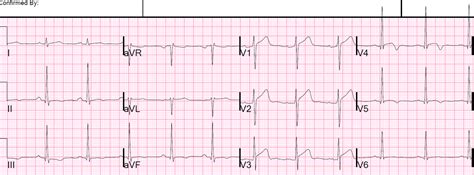 Dr. Smith's ECG Blog: Anterior STEMI?