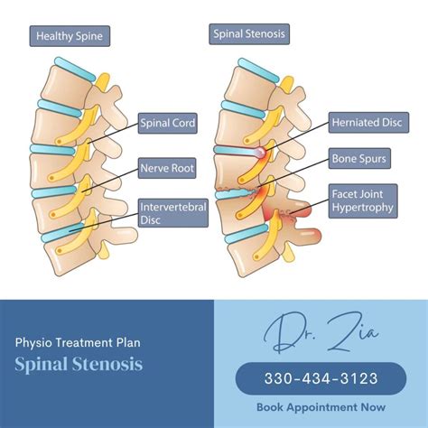 Spinal Stenosis | Causes, Treatment & Preventions